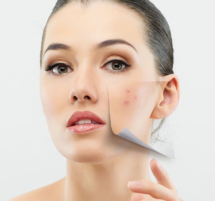 resized_1Acne-Problems-For-Women-5