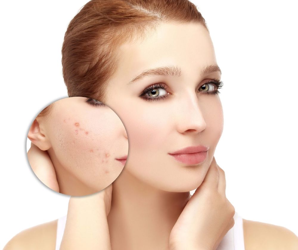 الموز وصفة طبيعية لعلاج حب الشباب