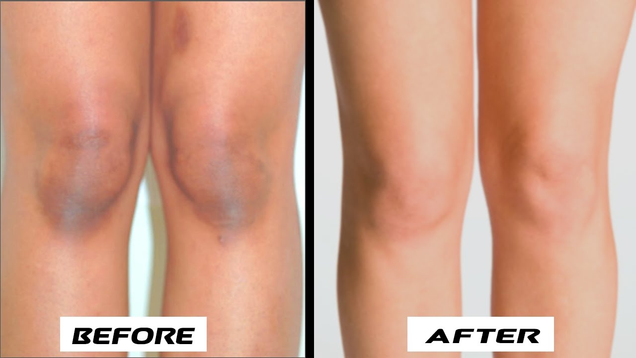 استخدمات بيكربونات الصوديوم في تبييض الركب