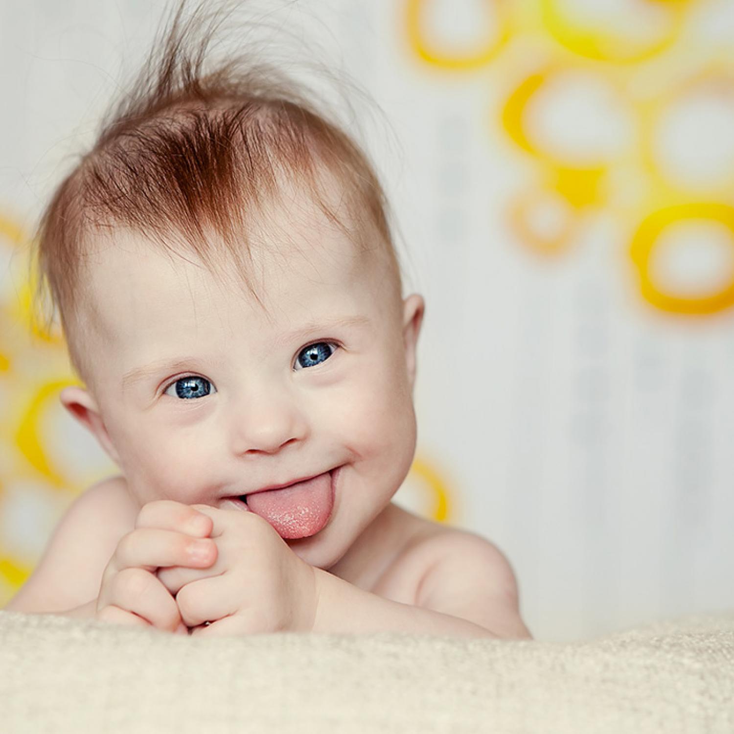 متلازمة داون