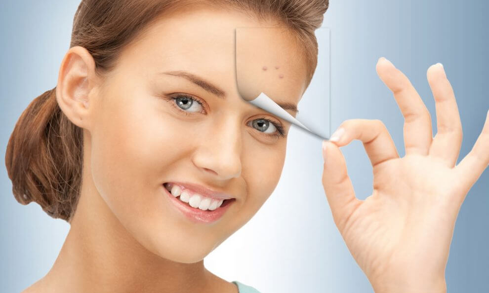 التخلص من حبوب الشباب بدون مكياج