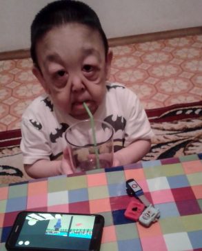 مرض نادر يحول طفل إلى رجل ستيني عجوز