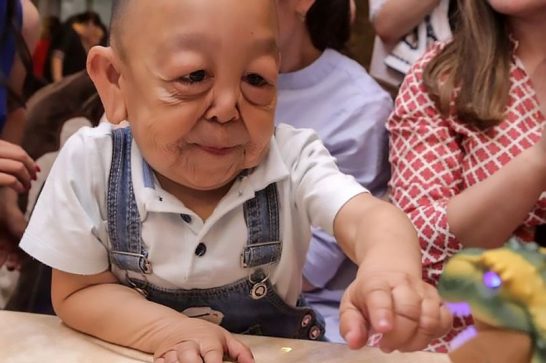 مرض نادر يحول طفل إلى رجل ستيني عجوز