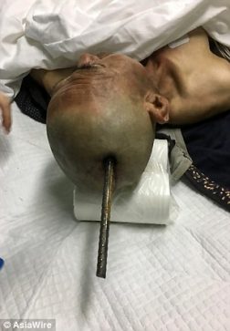 بالصور نجاة عامل صيني بعد اختراق سيخ حديدي لجمجمته