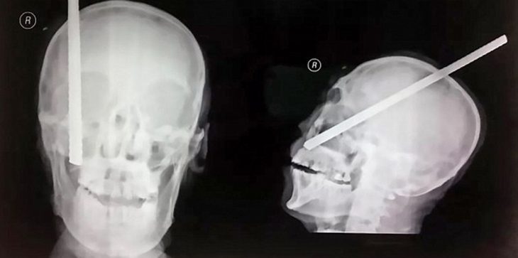 بالصور نجاة عامل صيني بعد اختراق سيخ حديدي لجمجمته