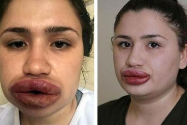 طبيب تجميل مزيف يشوه وجه فتاة.. وهذا جزاء فعلته!