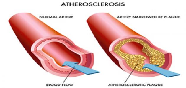 حرق-الدهون- (7)