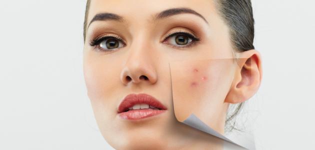علاج حب الشباب بطريقة طبيعية