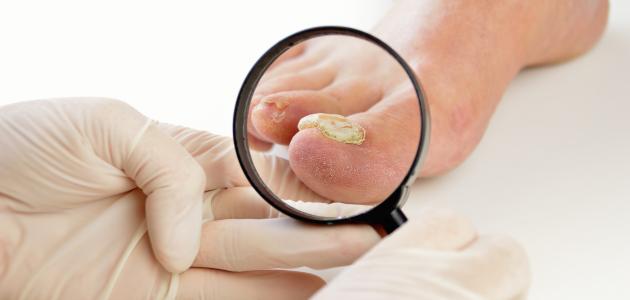 علاج فطريات القدم بالملح