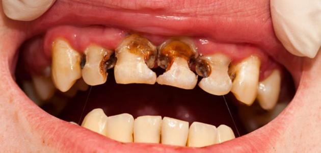 طبيب سعودي يكشف علاقة تناول البنزين بعلاج تسوس الأسنان !