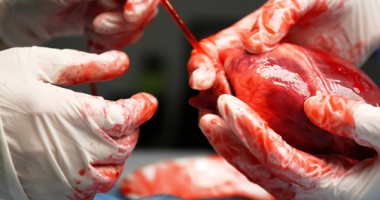 سيدة سعودية تنقذ ٦ أشخاص من الموت بعد أن تبرعت لهم بأعضائها