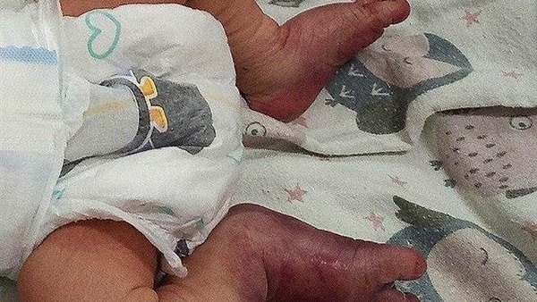 بالصور.. داية تعرض الأم لحالة حرجة أثناء الولادة وتكسر قدم المولود