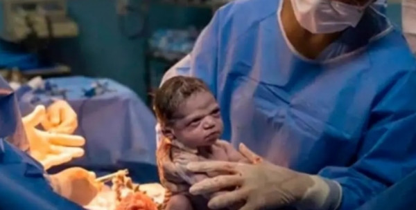 بالصور.. مولودة ترفض البكاء وتنظر للطبيب في غضب 