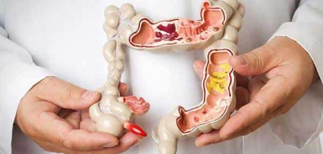 علامات وأعراض سرطان قاتل في الأمعاء الغليظة