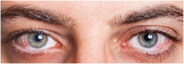 هل الصيام يسبب جفاف في العين؟