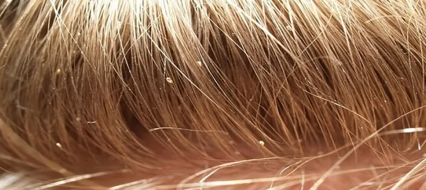رؤية القمل في الشعر في المنام لابن سيرين