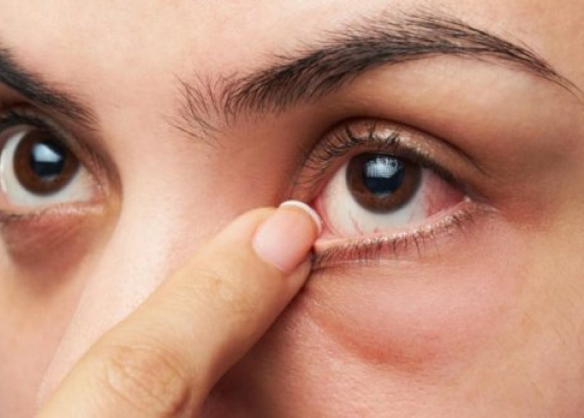 علاج الكلور في العين