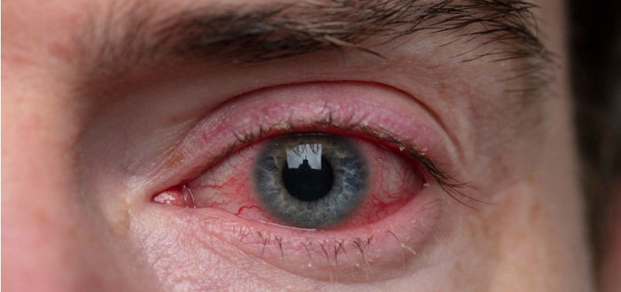 علاج الكلور في العين