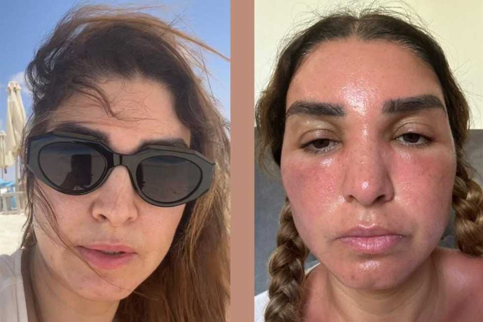 روجينا تتعرض لحروق بوجهها وتنشر صورتها عبر إنستجرام